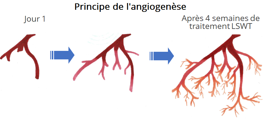 angiogenèse traitement ondes de choc dysfonction érectile